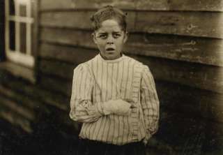 1912 child labor photo Accident to young mill work  